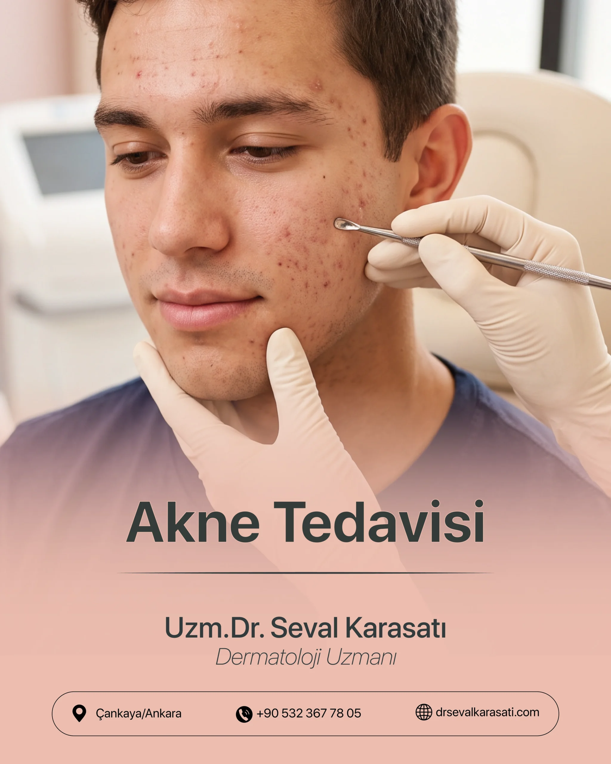 Akne Tedavisi