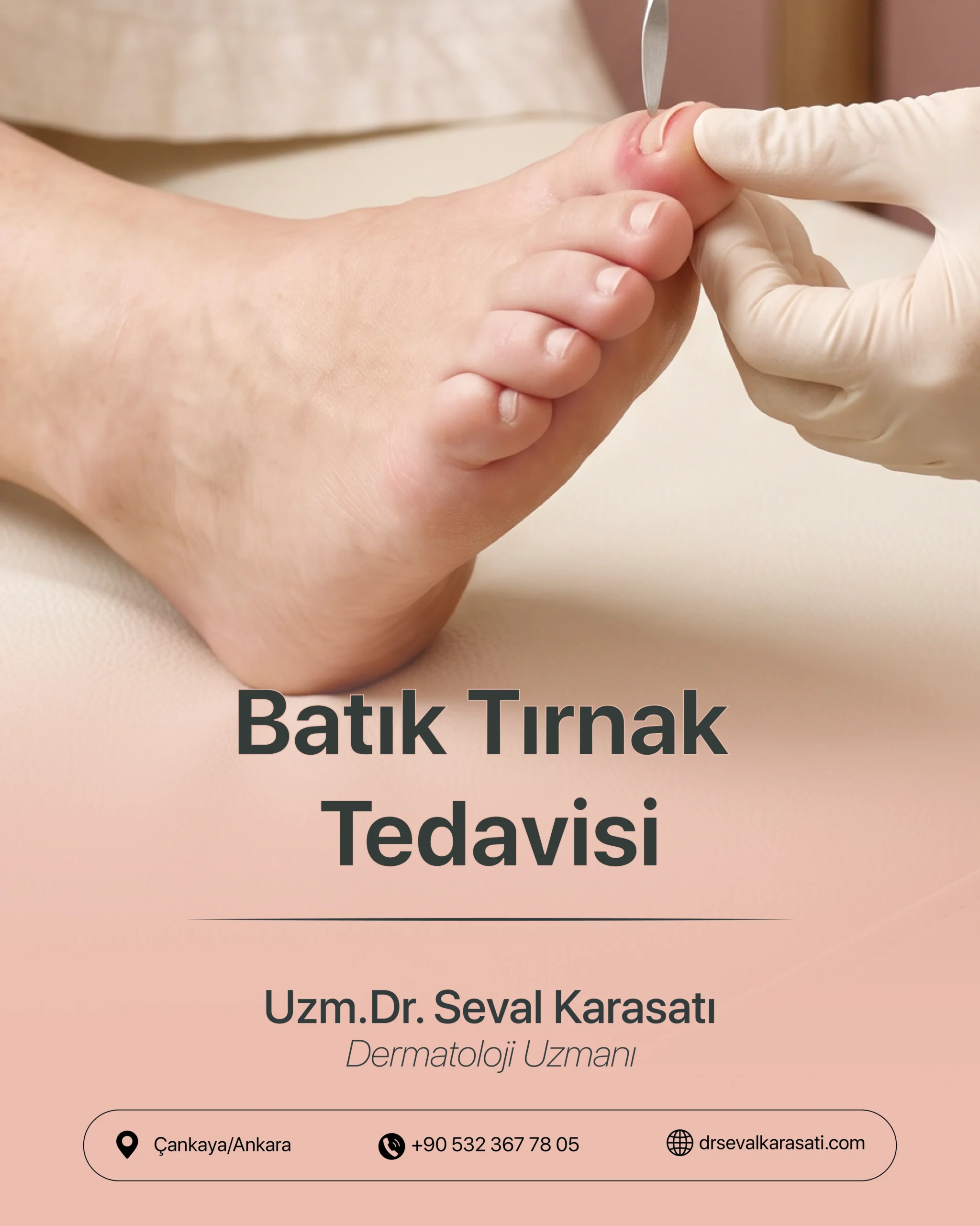 Batık Tırnak Tedavisi