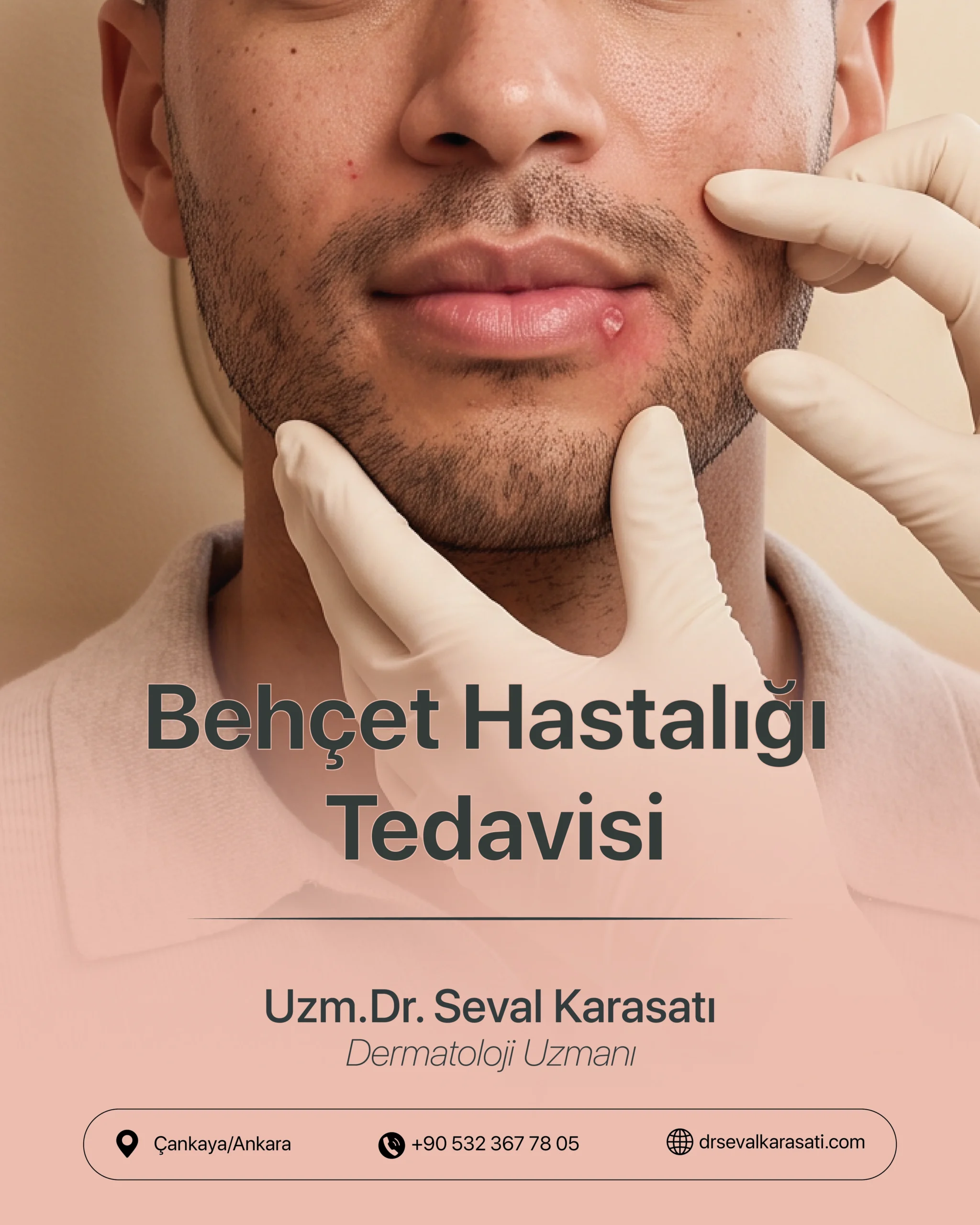 Behçet Hastalığı Tedavisi