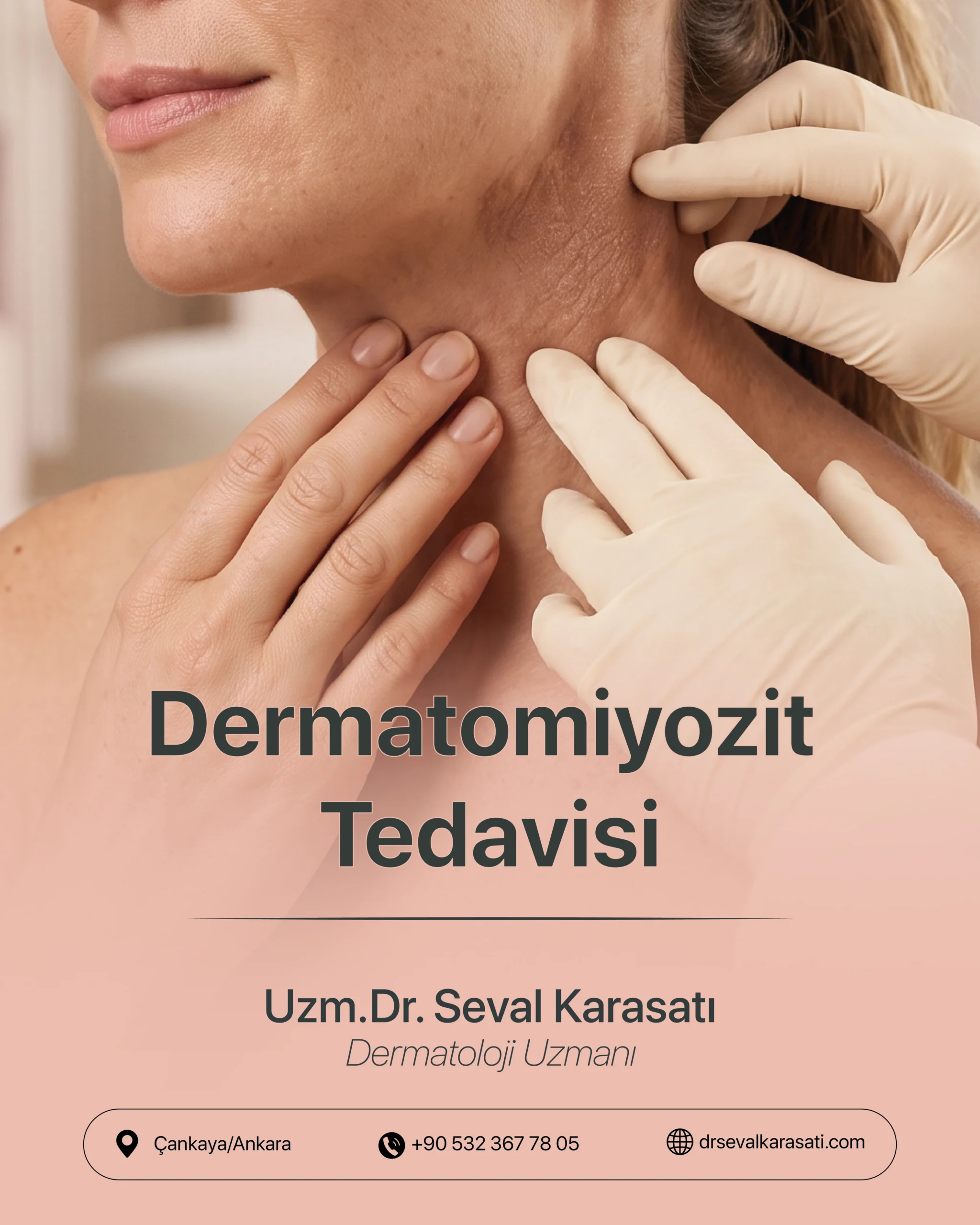 Dermatomiyozit Tedavisi