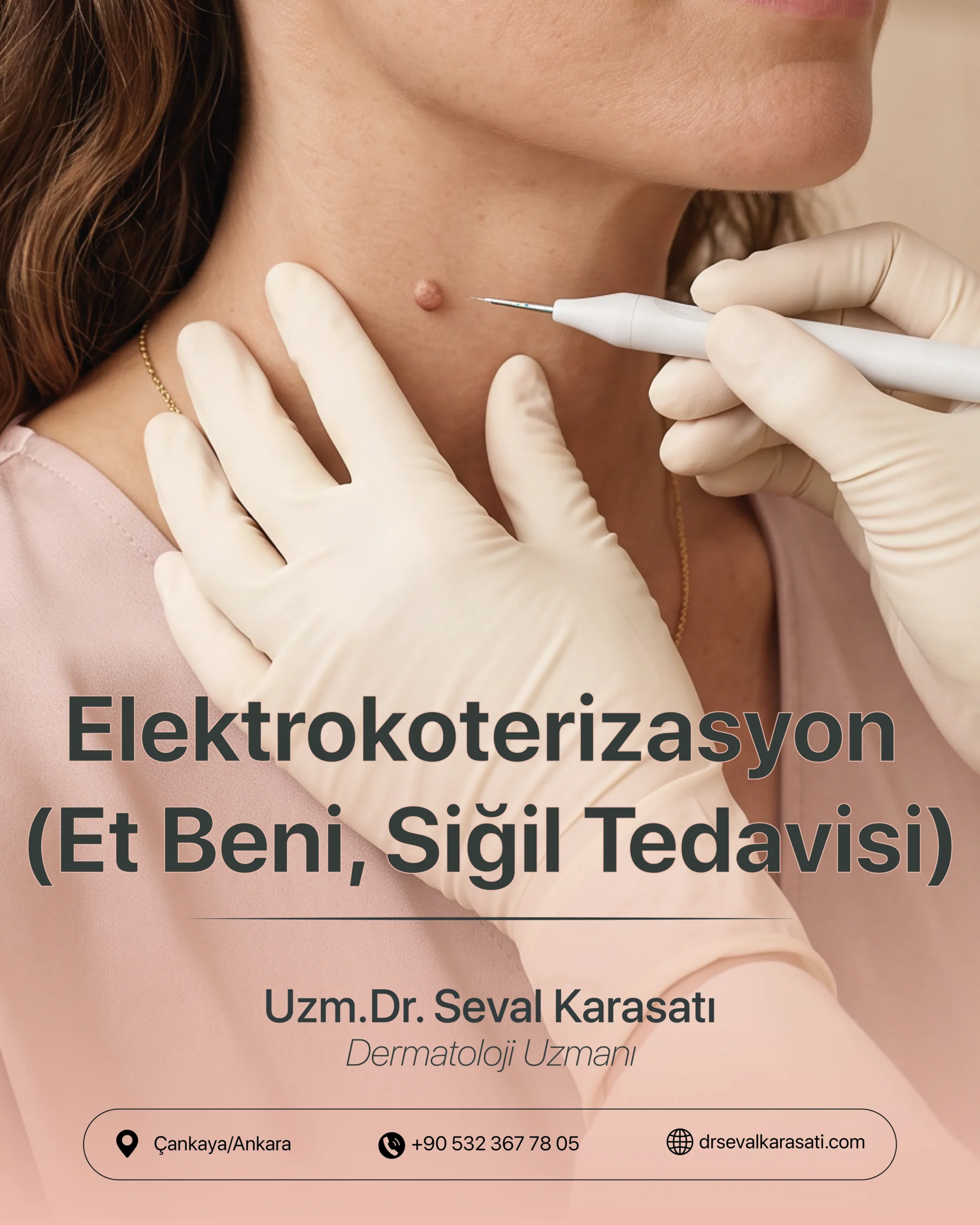 Elektrokoterizasyon (Et Beni, Siğil Tedavisi)