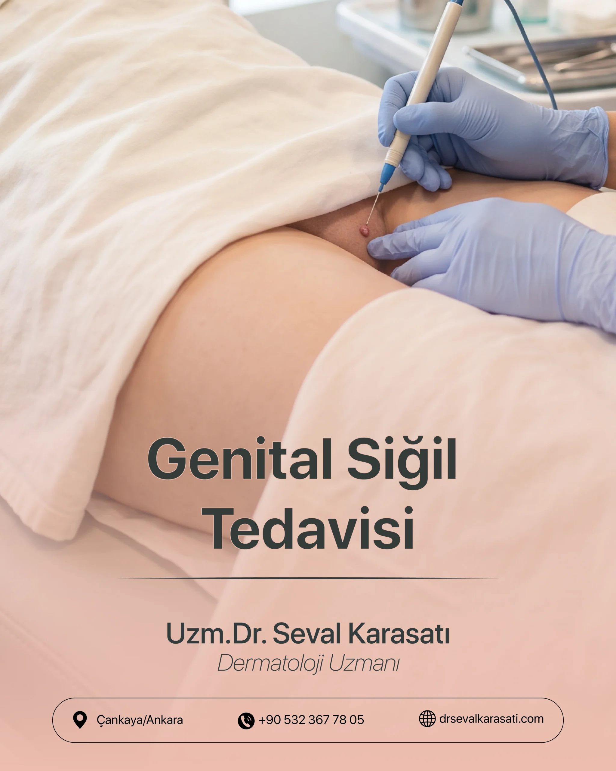 Genital Siğil Tedavisi