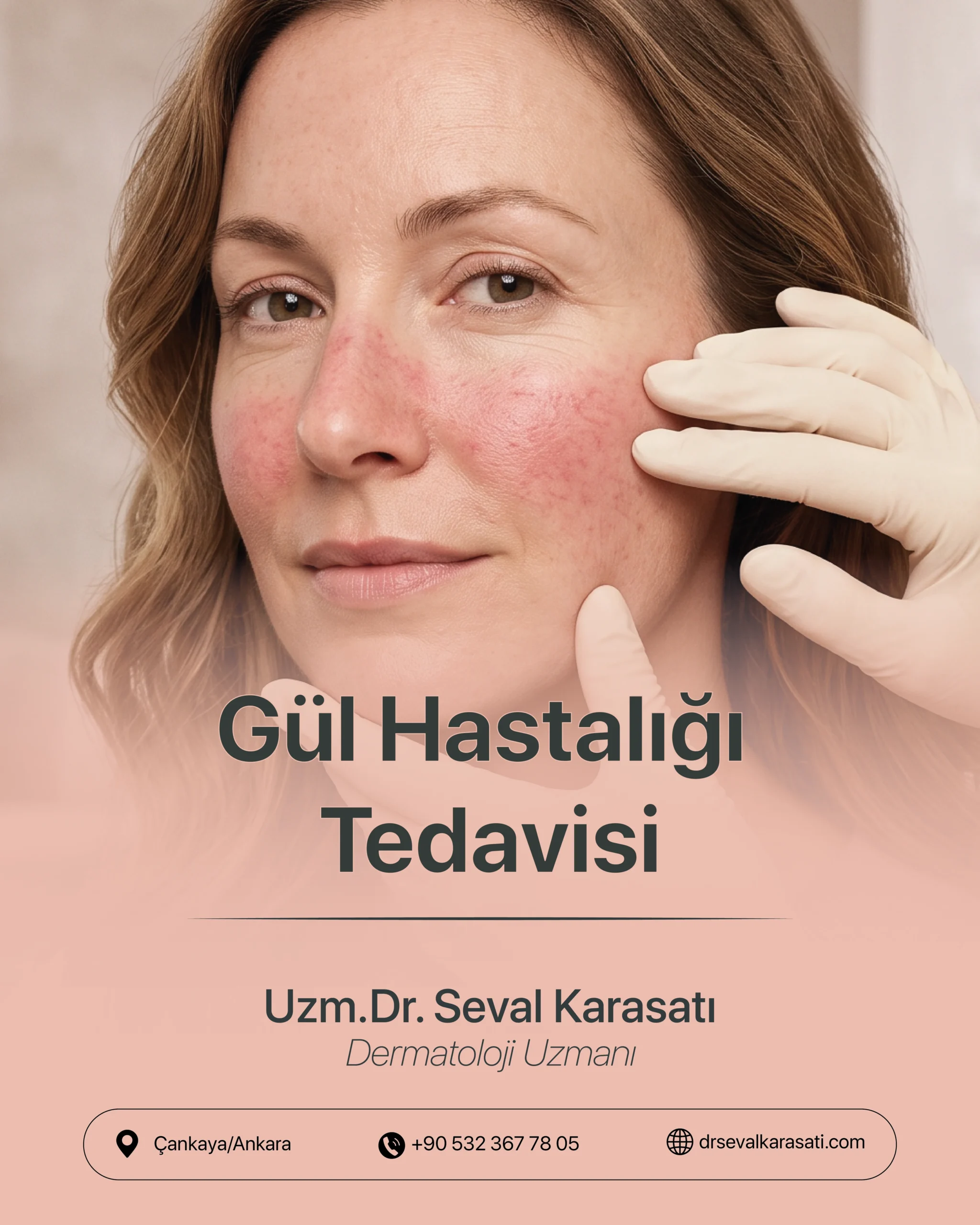 Gül Hastalığı Tedavisi