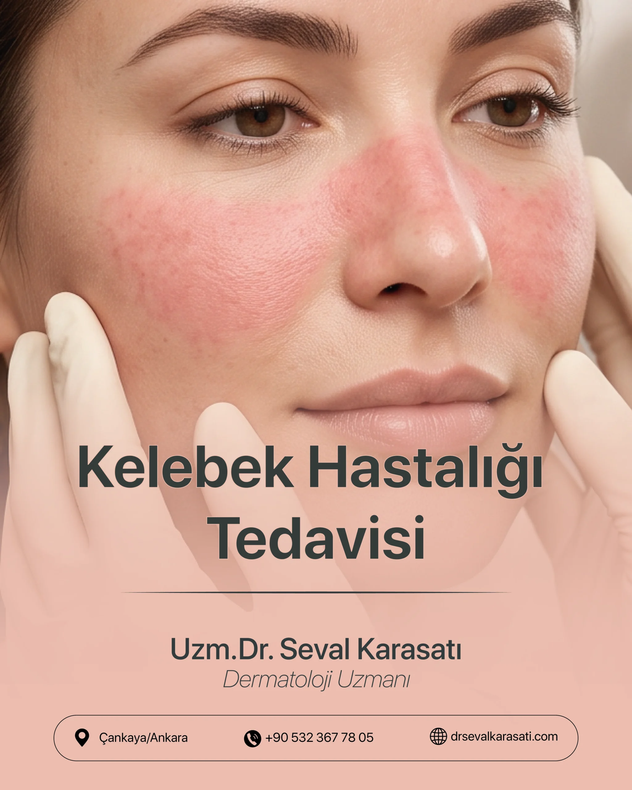 Kelebek Hastalığı Tedavisi