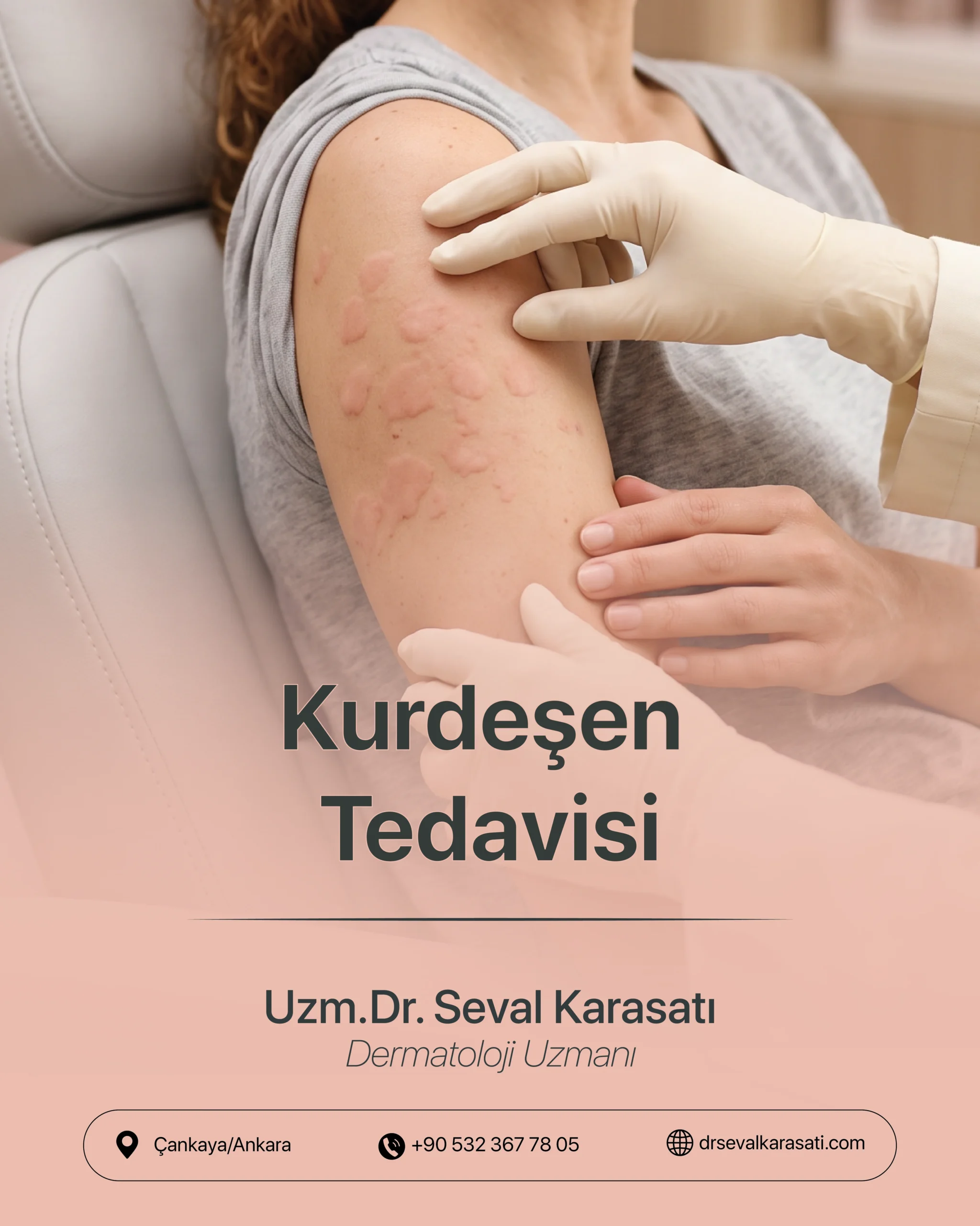 Kurdeşen Tedavisi