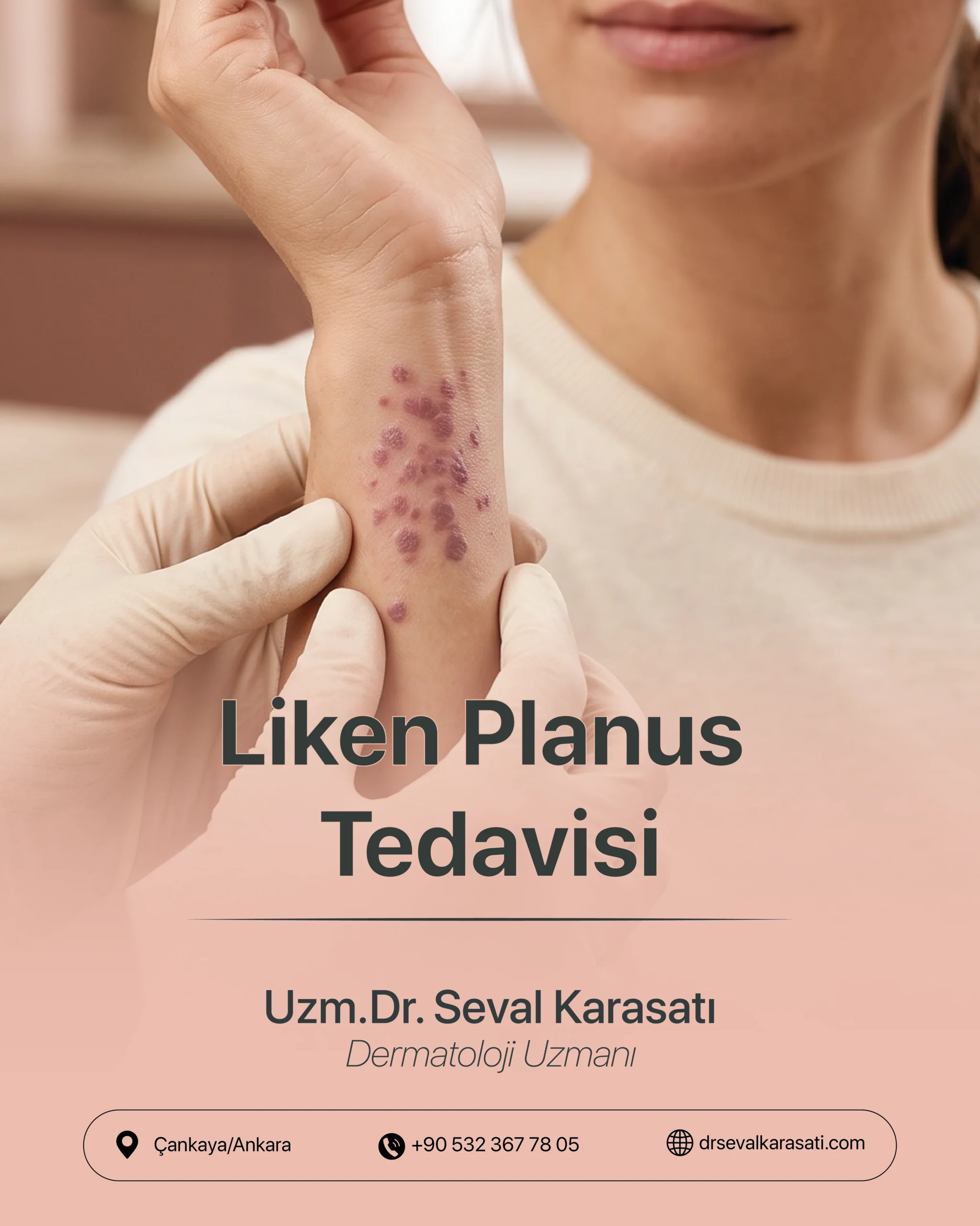 Liken Planus Tedavisi