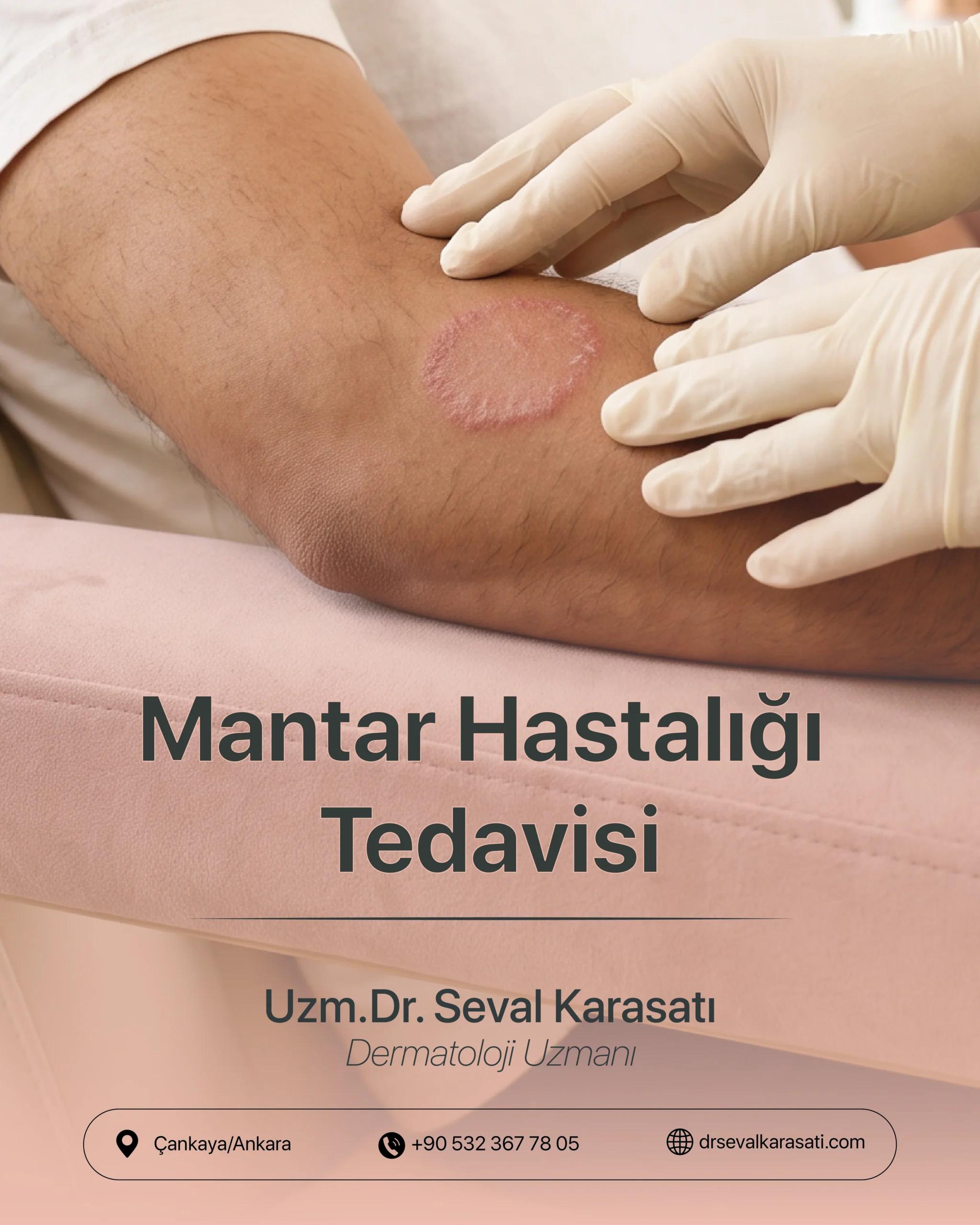 Mantar Hastalığı Tedavisi