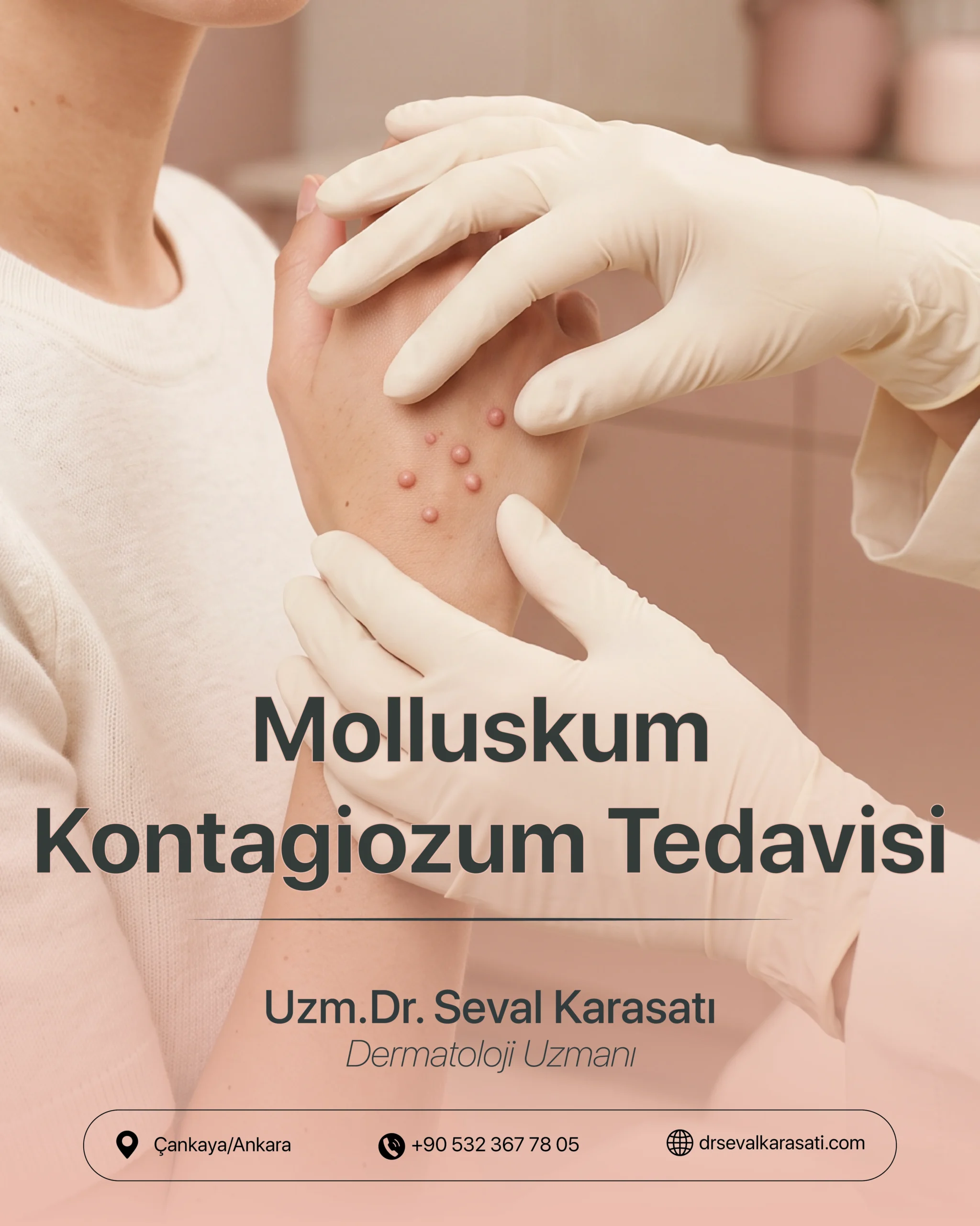 Molluskum Kontagiozum Tedavisi