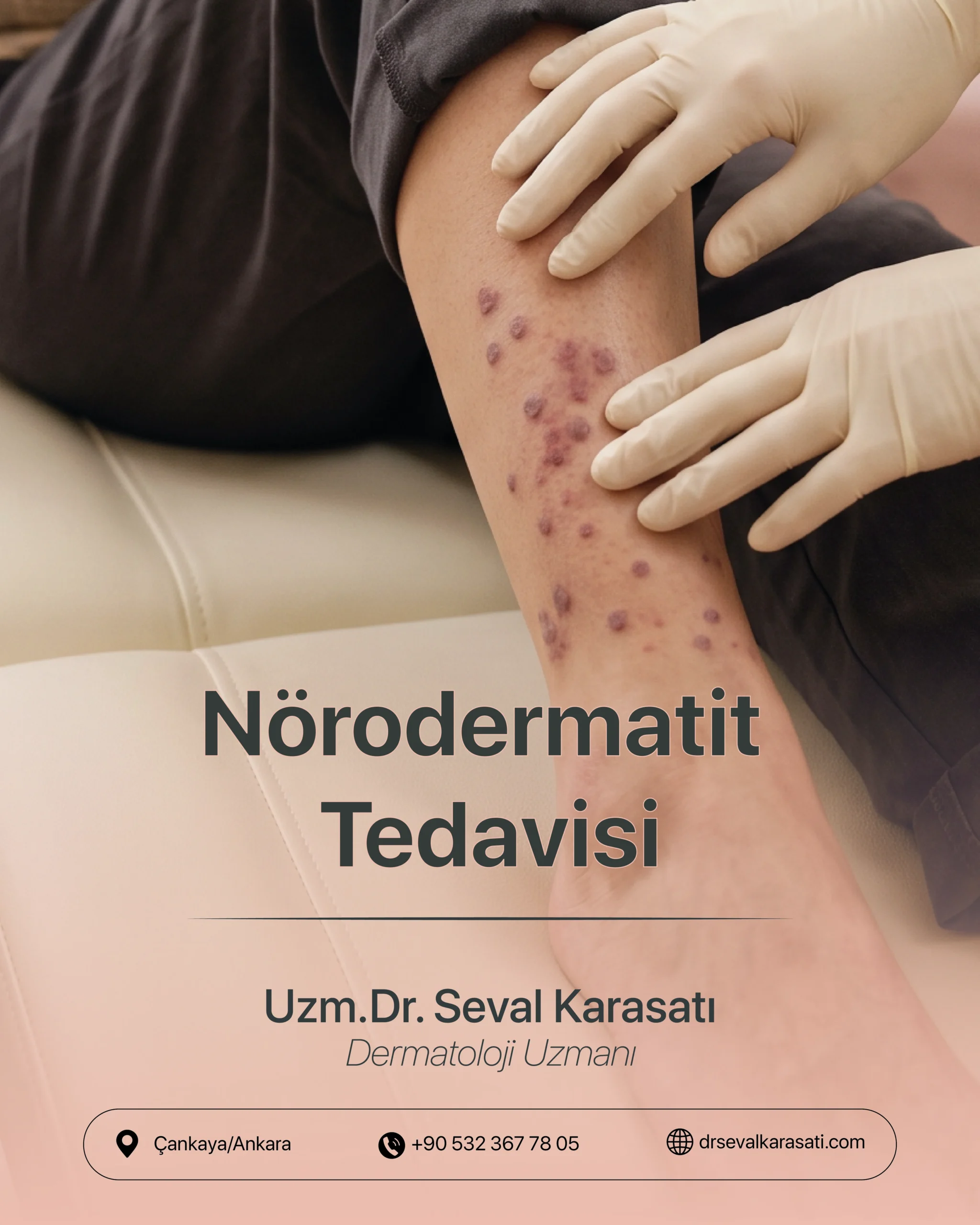 Nörodermatit Tedavisi
