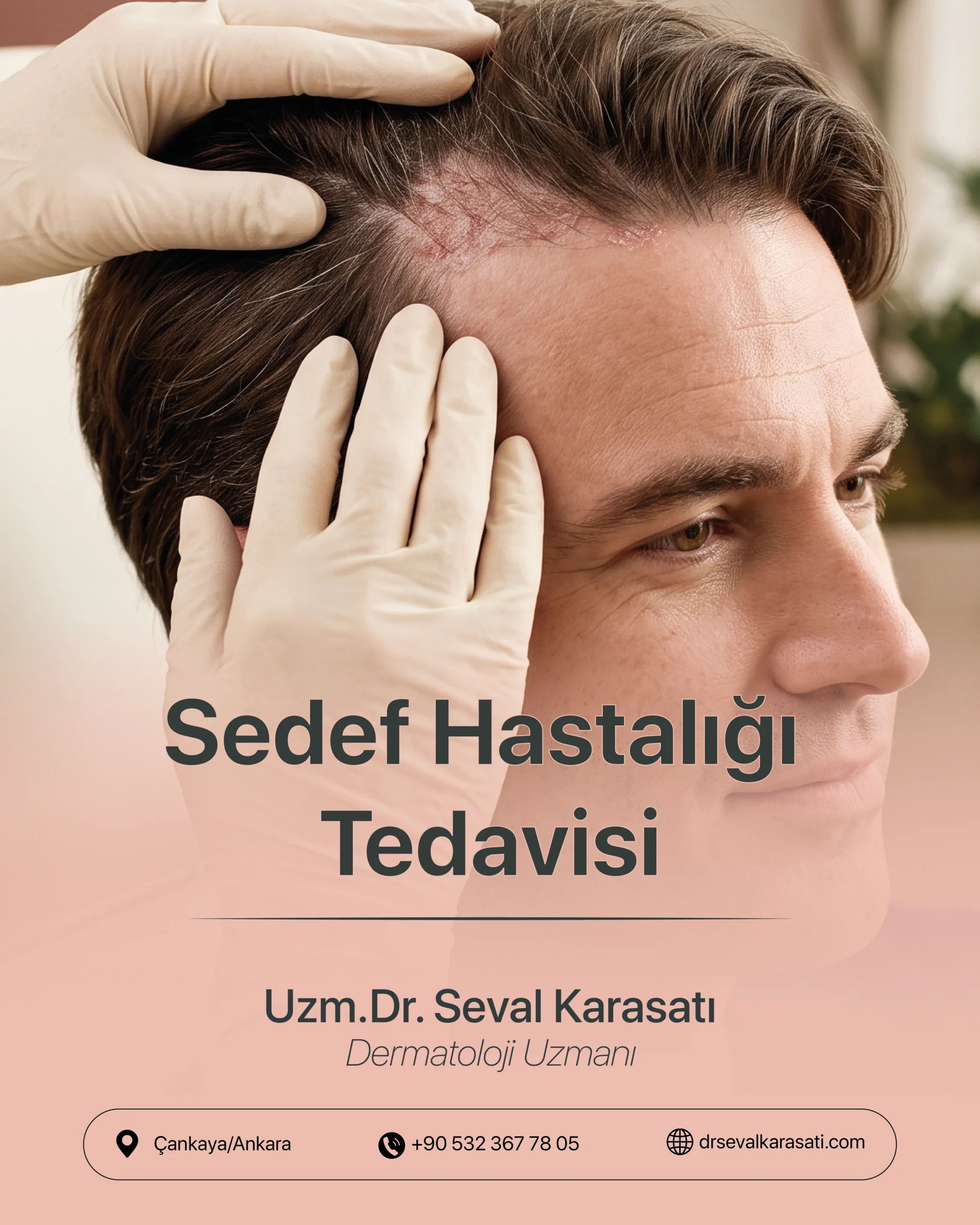 Sedef Hastalığı Tedavisi