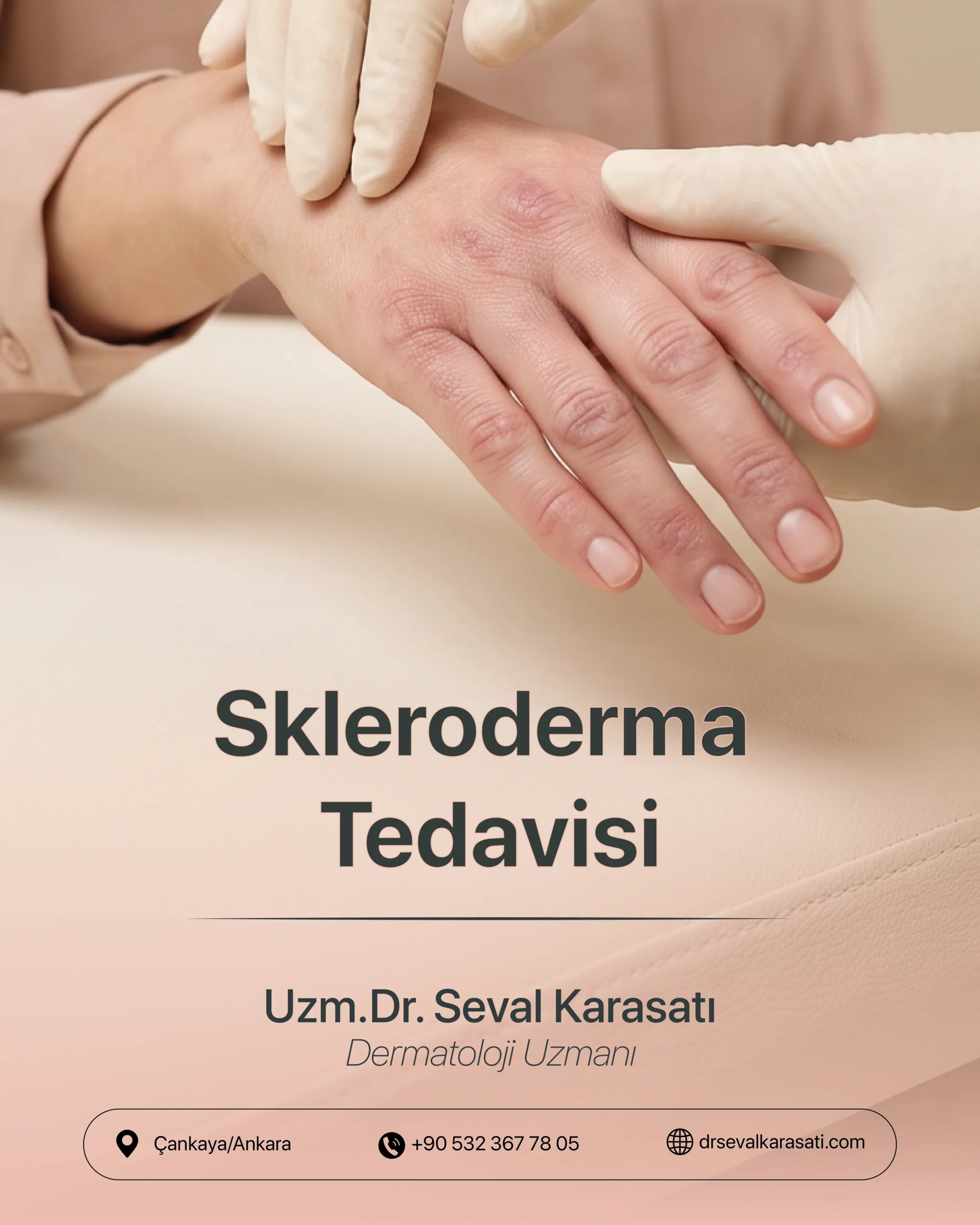 Skleroderma Tedavisi