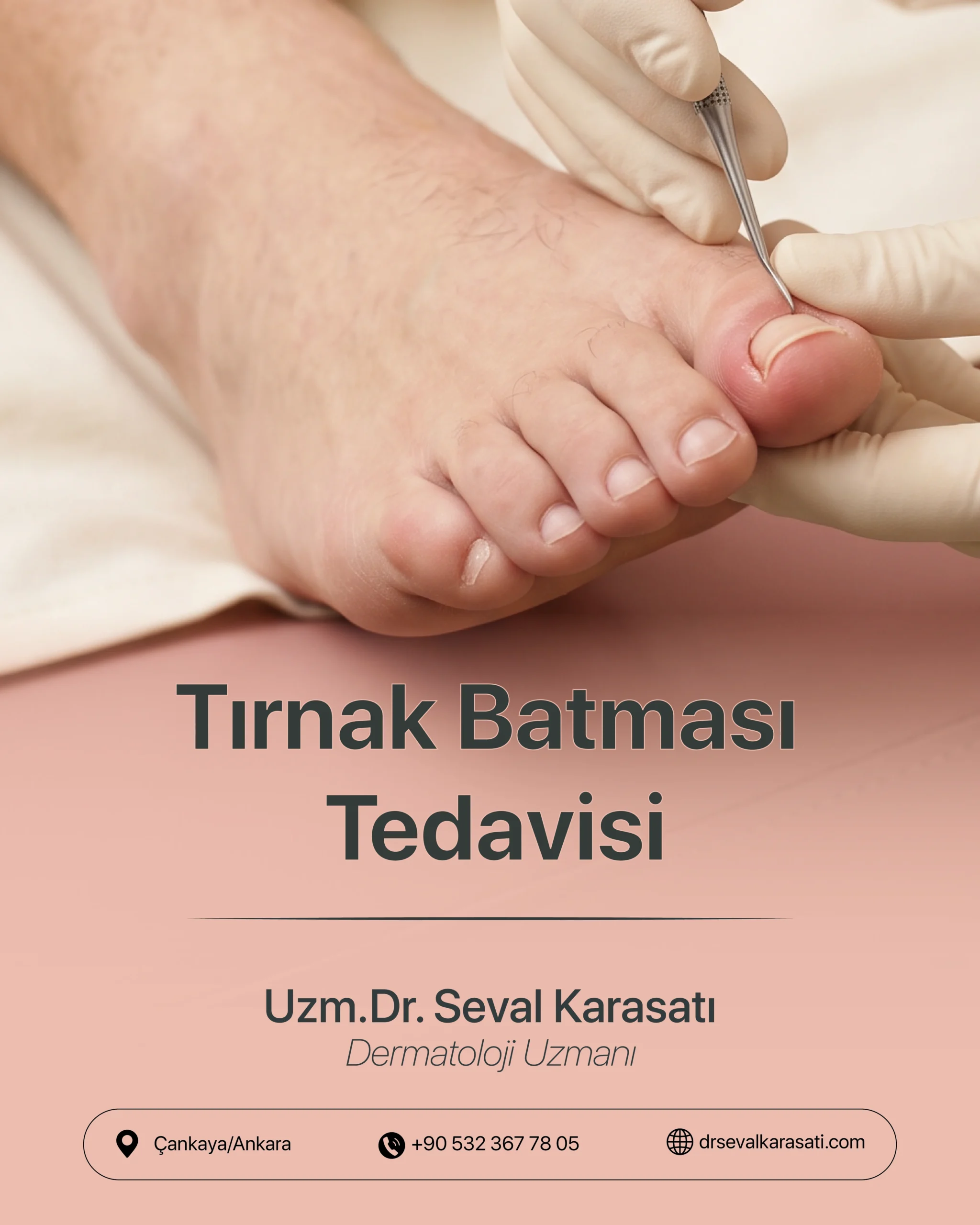 Tırnak Batması Tedavisi