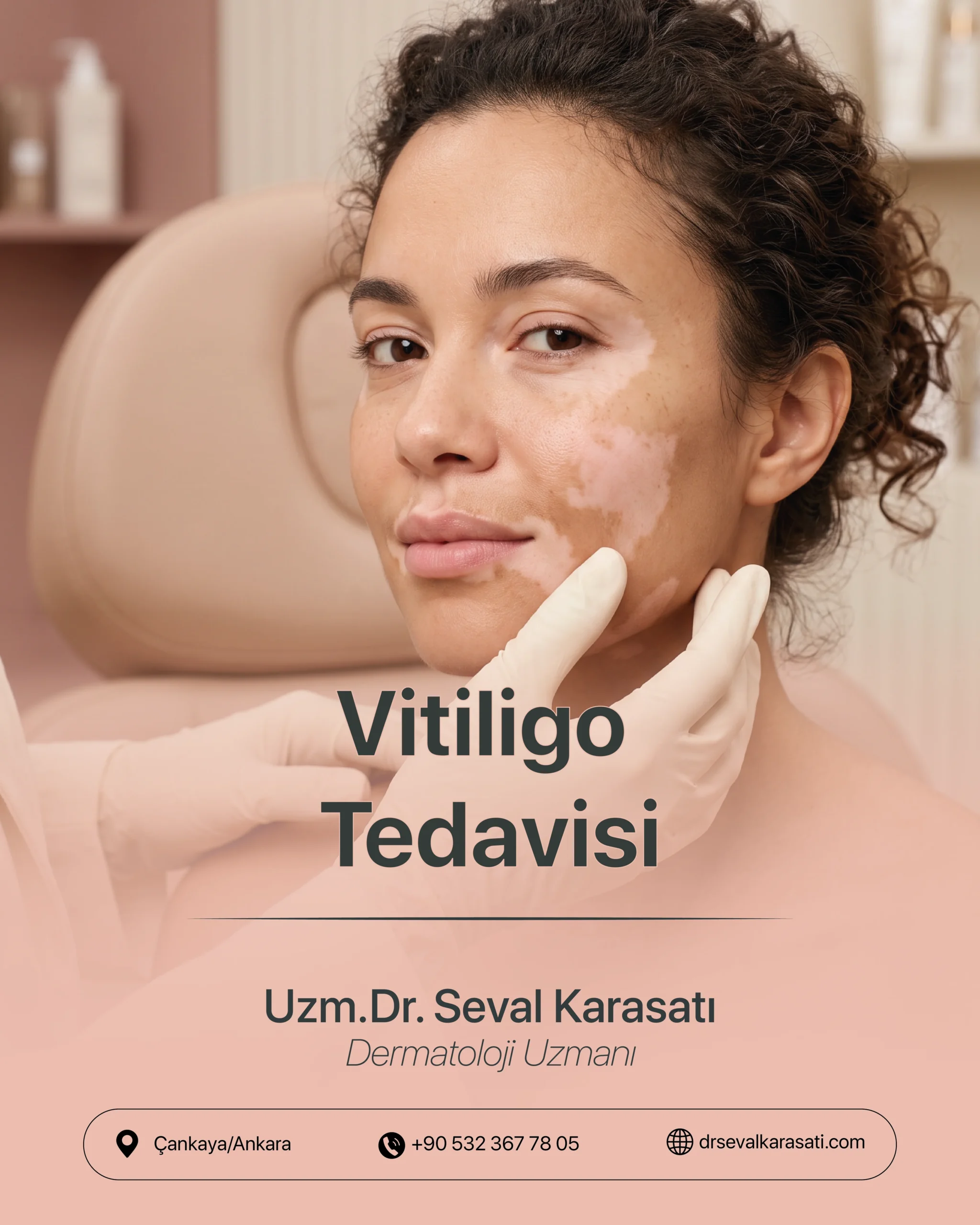 Vitiligo Tedavisi